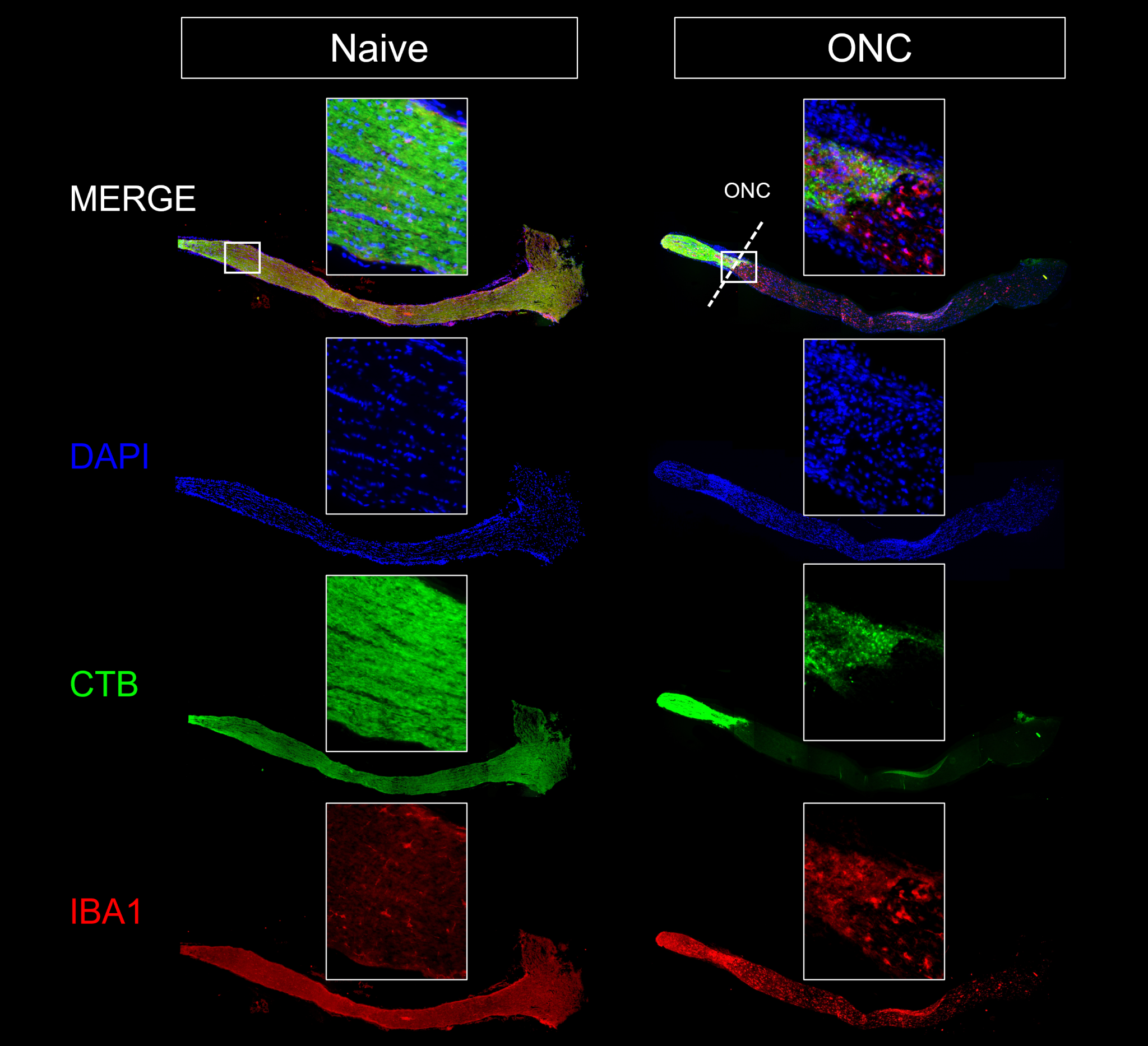ONC IBA and CTB
