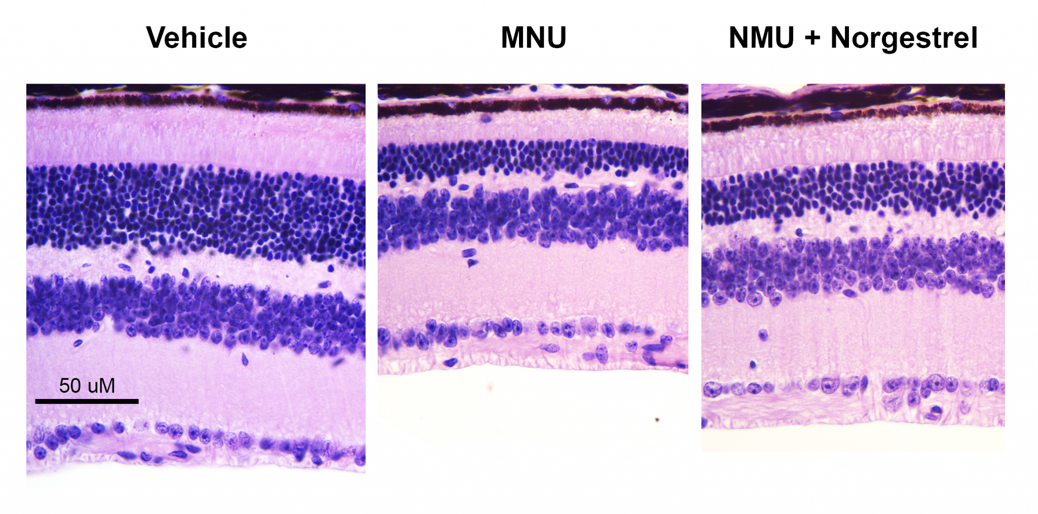 MNU Degeneration